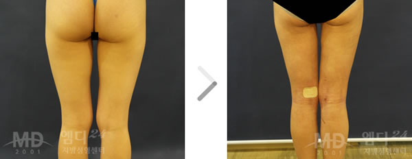 大腿臀部吸脂手术前后对比照片
