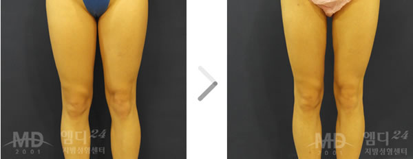 大腿吸脂整形前后对比照片