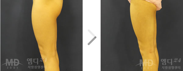 大腿及臀部吸脂手术前后对比照片