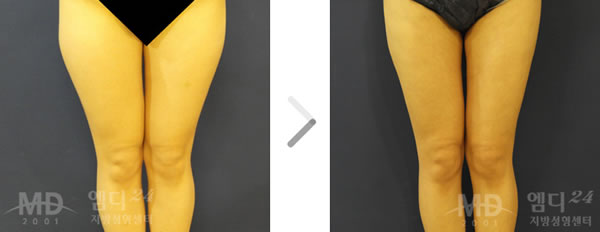 大腿吸脂前后对比照片