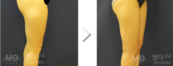 大腿吸脂整形前后对比照片