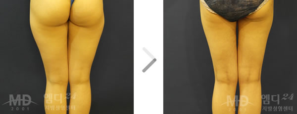 大腿吸脂术前后对比照片