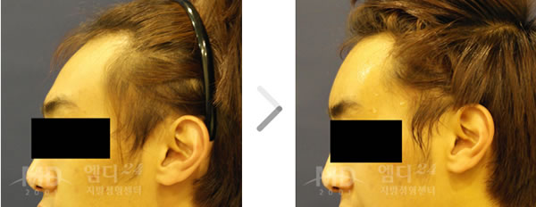 丰额头整形术前后对比照片