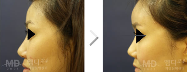 丰额头整形术前后对比照片