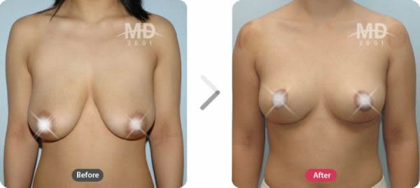 韩国MD整形外科假体隆胸+乳晕缩小+乳房下垂矫正手术对比案例