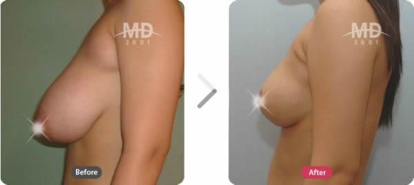韩国MD整形外科巨乳缩小+乳晕缩小+副乳切除对比案例