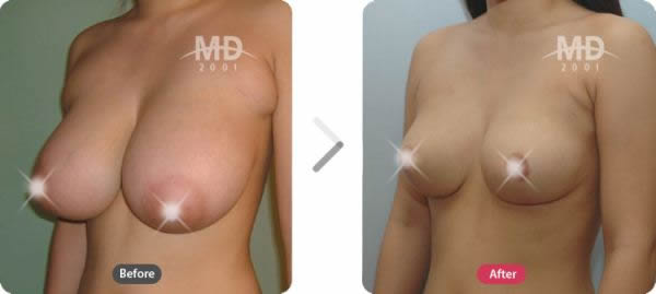 韩国MD整形外科巨乳缩小与乳晕缩小对比案例