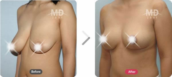 韩国MD整形外科假体隆胸手术+乳房下垂矫正手术对比案例
