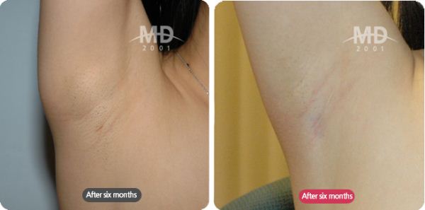 韩国MD整形外科胸部整形手术腋下疤痕对比案例