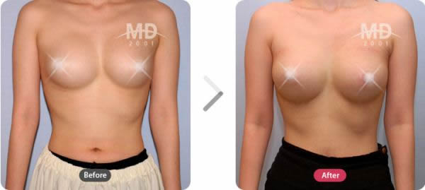 假体隆胸手术前后对比照片