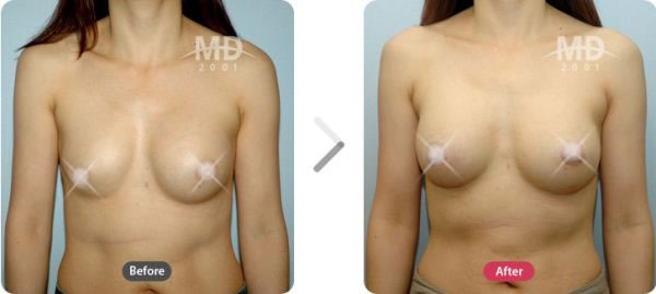 乳房不对称矫正术前后对比照片