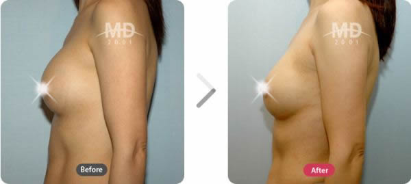 巨乳缩小整形术前后对比照片