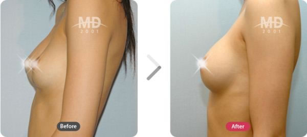 乳房不对称矫正整形手术前后对比案例