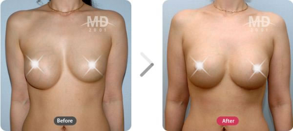 乳房左右不对称矫正术前后对比照片