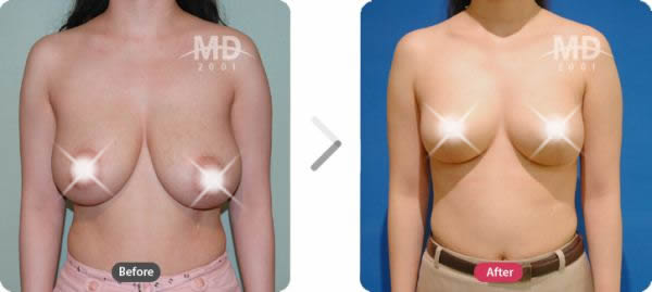 韩国MD整形外科乳房下垂矫正术+乳晕缩小术对比案例