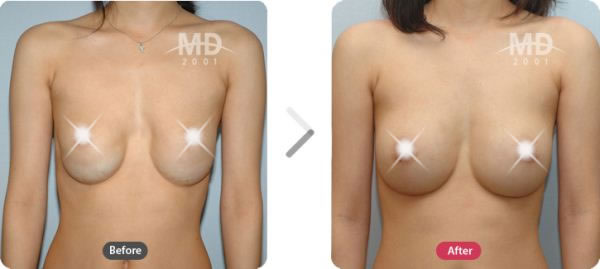 乳房下垂矫正手术前后对比照片