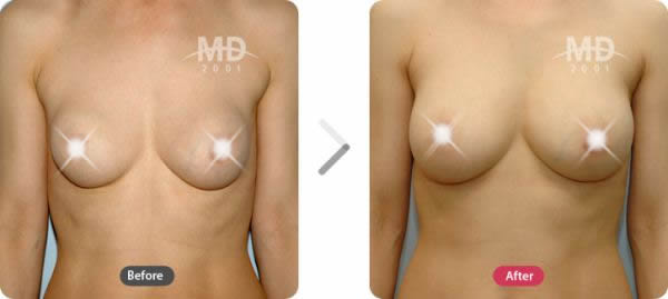 假体隆胸整形术前后对比照片