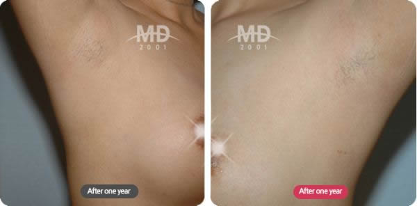 韩国MD整形外科胸部整形疤痕情况对比案例