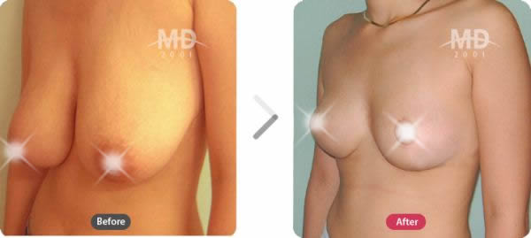韩国MD整形外科巨乳缩小对比案例