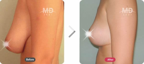 韩国MD整形外科乳房下垂矫正对比案例