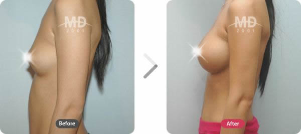 韩国MD整形外科假体隆胸对比案例