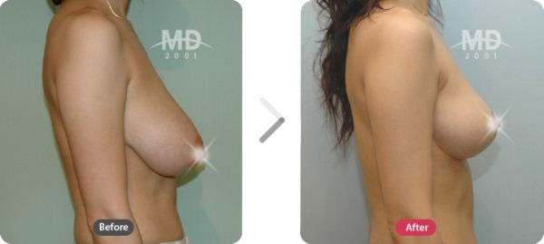 韩国MD整形外科胸部下垂矫正术+假体隆胸对比案例