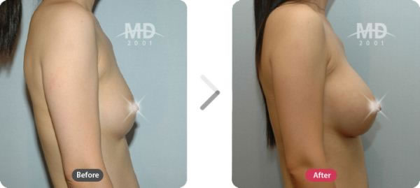 韩国MD整形外科假体隆胸对比案例