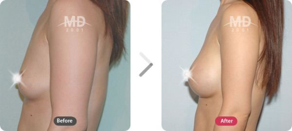 隆胸整形手术前后对比照片