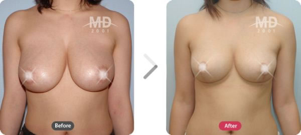 韩国MD整形外科乳房外扩矫正术对比案例