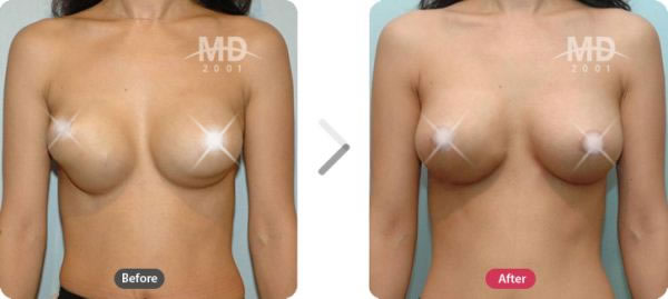 乳房畸形矫正整形手术前后对比照片