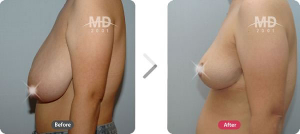 韩国MD整形外科巨乳缩小+乳房下垂矫正对比案例