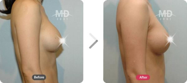 隆胸整形手术前后对比照片