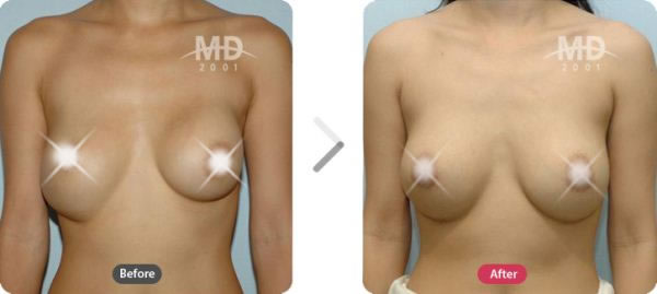 乳房矫正整形术前后对比照片