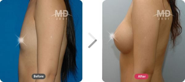 韩国MD整形外科假体隆胸手术对比案例 