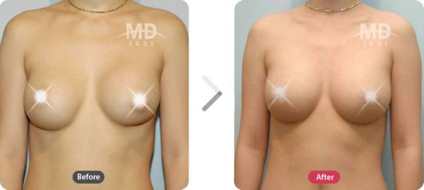 胸部整形手术前后对比照片