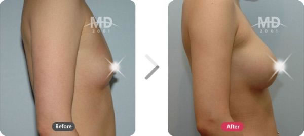 假体隆胸术前后对比照片