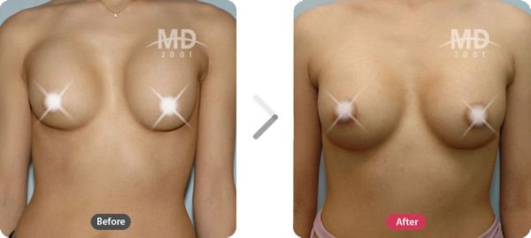 韩国MD整形外科假体隆胸对比案例