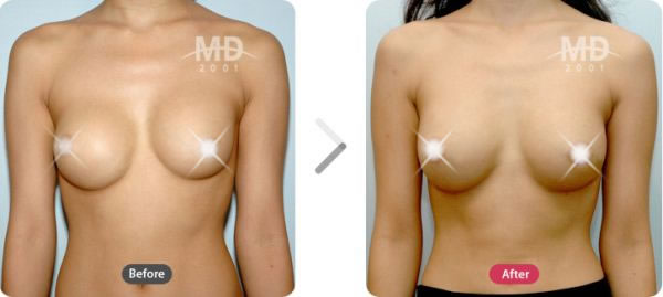 乳头矫正整形术前后对比照片