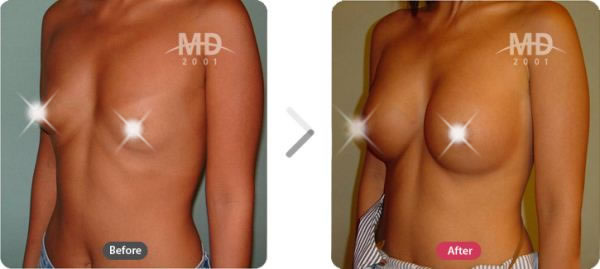 假体隆胸整形术前后对比照片