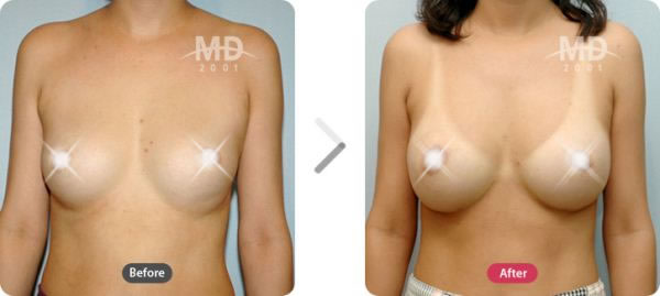 隆胸手术前后对比照片