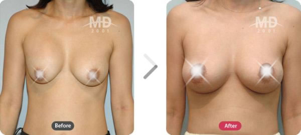 韩国MD整形外科假体隆胸术对比案例