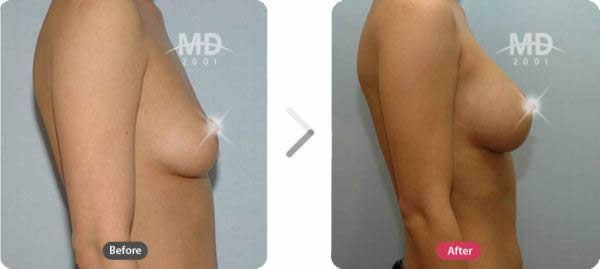 韩国MD整形外科假体隆胸术对比案例
