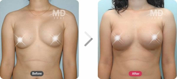 假体隆胸整形手术前后对比照片