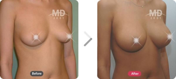 韩国MD整形外科假体隆胸术对比案例