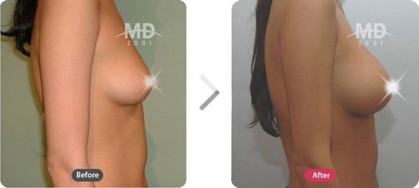 假体隆胸整形前后对比照片