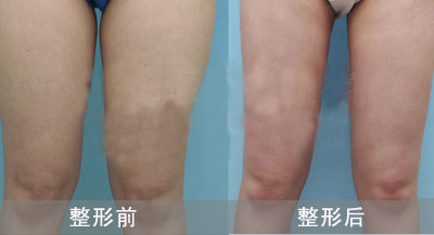 上海原辰整形大腿吸脂手术对比案例