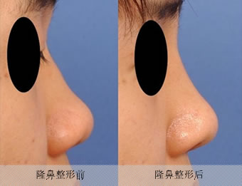 隆鼻整形手术对比案例