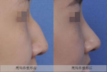 鹰钩鼻修复手术对比案例