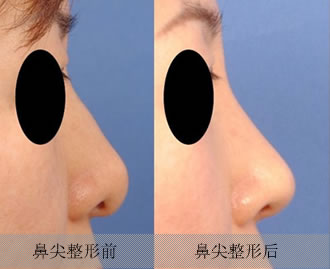 鼻尖矫正手术对比案例