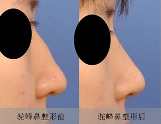 驼峰鼻矫正手术对比案例
